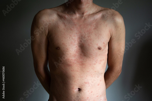 Body of adult man have spotted, red pimple and bubble rash from chickenpox or varicella zoster virus. Medical complications after illness.