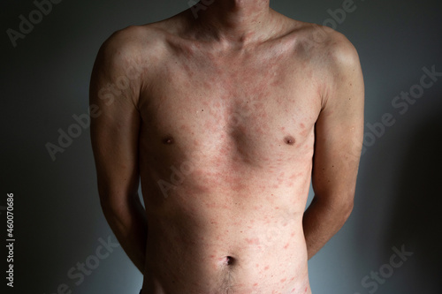 Фотография Body of adult man have spotted, red pimple and bubble rash from chickenpox or varicella zoster virus