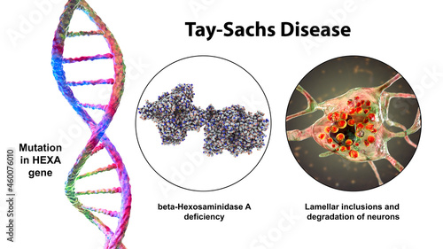 Tay-Sachs disease, 3D illustration photo