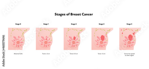 Human breast cancer anatomy diagram. Vector flat medical illustration. Front view. Stages of tumor disease isolated on white background. Design for healthcare, science, education, oncology.