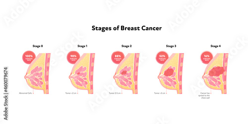 Human breast cancer anatomy diagram. Vector flat medical illustration. Side view. Survival rate. Stages of tumor disease isolated on white background. Design for healthcare, education, oncology. photo