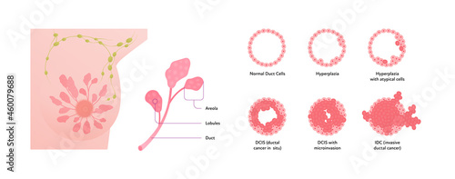 WebHuman breast cancer anatomy diagram. Vector flat medical illustration. Front view. Stages disease and tumor cells isolated on white background. Design for healthcare, science, education, oncology.