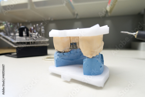 model of the human jaw with dental implants