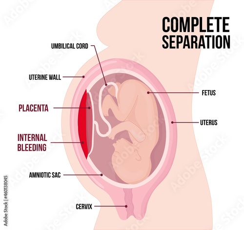 child in womb. Complete separation of placenta, placental abruption. Internal bleeding. Dangerous complication of pregnancy, threat of miscarriage. photo