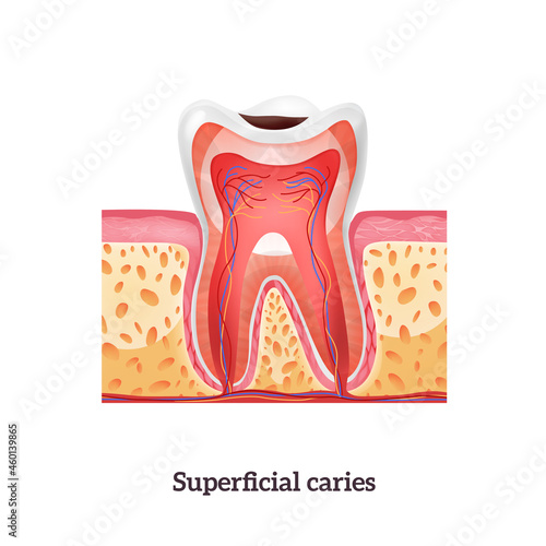 Caries Tooth Anatomy
