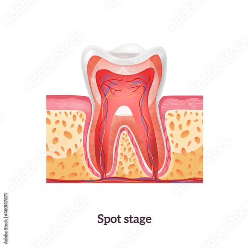 Realistic Caries Tooth Anatomy