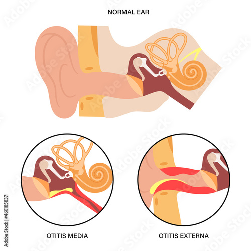 Externa media otitis