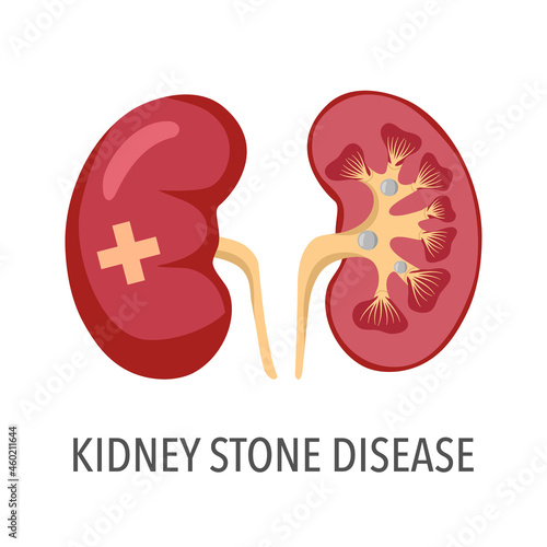 Kidney stone disease concept vector illustration on white background.