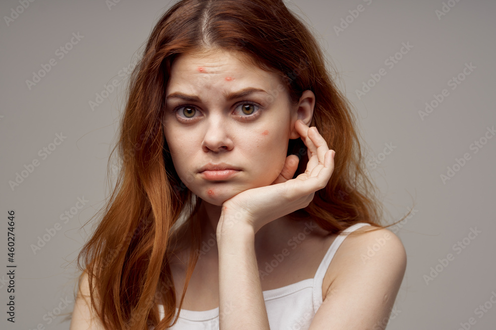 pretty woman in a white t-shirt pimples on the face light background pretty woman in a white t-shirt pimples on the face light background