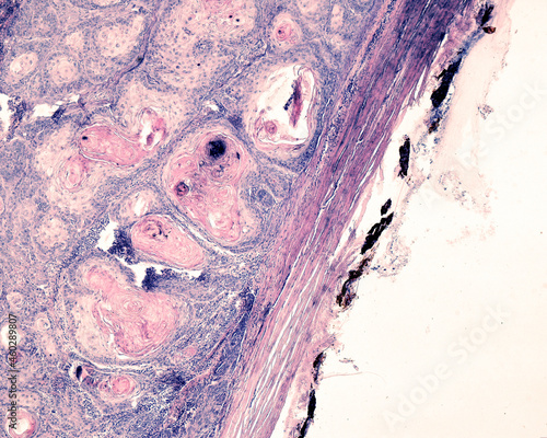 Squamous cell carcinoma of the eyeball photo