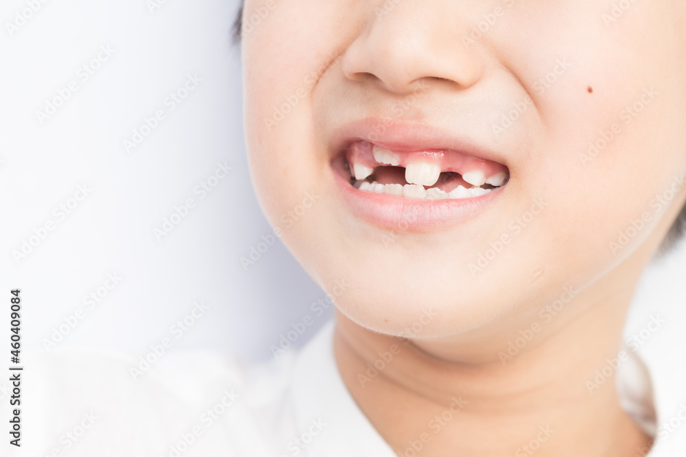 Obraz premium Little boy milk tooth falls out as new ones are growing.