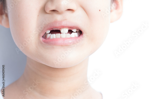 Little boy milk tooth falls out as new ones are growing.