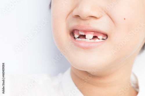 Little boy milk tooth falls out as new ones are growing.