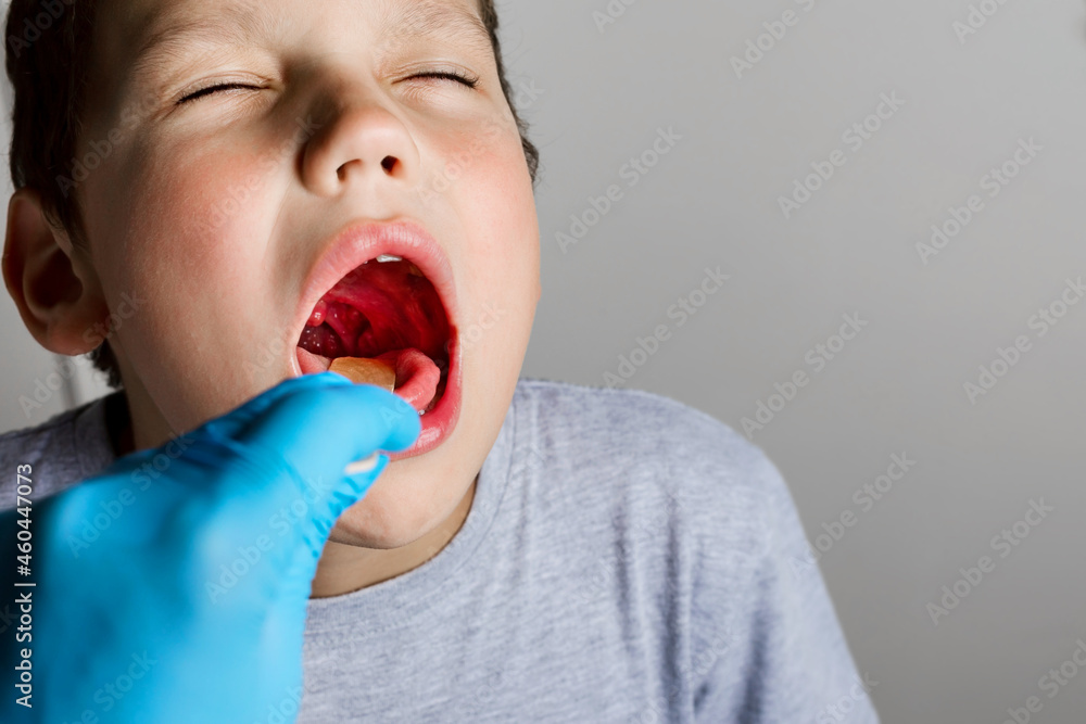 The boy's mouth is wide open with tonsils are enlarged, visible in the