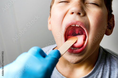 The boy's mouth is wide open with tonsils are enlarged, visible in the white or yellowish tinge on a gray background. Pediatrician checking 8-aged schoolboy's throat applying wooden spatula.