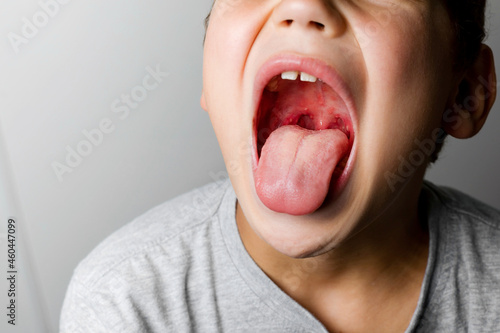 The boy's mouth is wide open with tonsils are enlarged, visible in them white or yellowish tinge on a gray background. Sore throat in children. photo