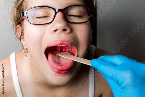 The girl's mouth is wide open with tonsils are enlarged, visible in the white or yellowish tinge on a gray background. Pediatrician checking 11-aged schoolgirls throat applying wooden spatula. photo