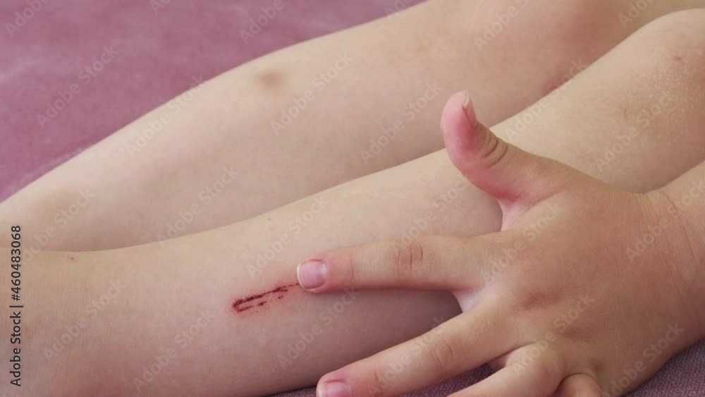 child injuries,kids injured in the leg while playing, child injuries,kids injured in the leg while playing,