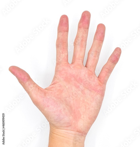 Cyanotic hands or peripheral cyanosis or blue hands at Southeast Asian, Chinese male patient