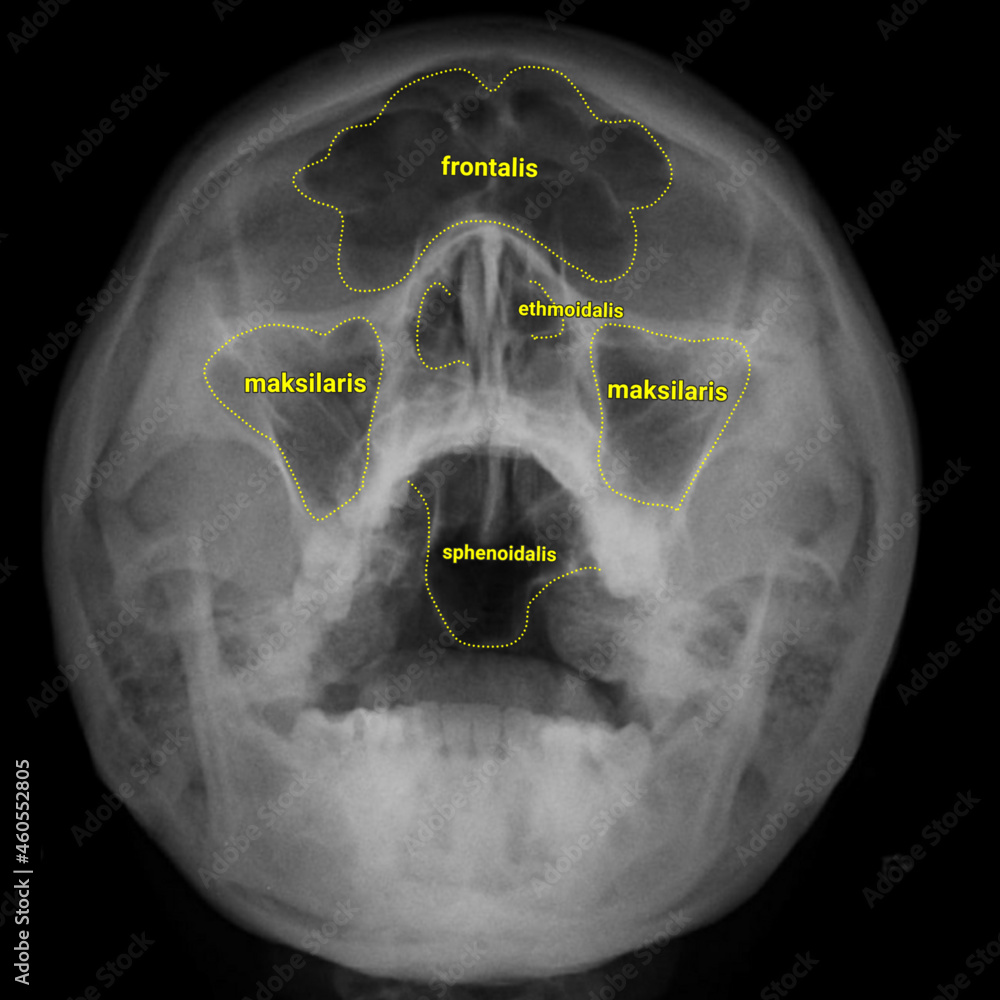 Waters xray paranasal sinus anatomy Stock Vector Adobe Stock