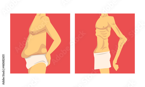 Male Torso with Sagging Belly and Soft Muscles Vector Set