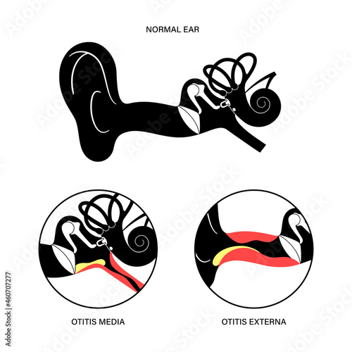 Externa media otitis