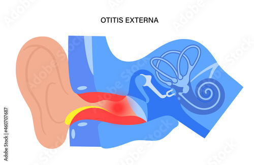 Swimmers ear otitis