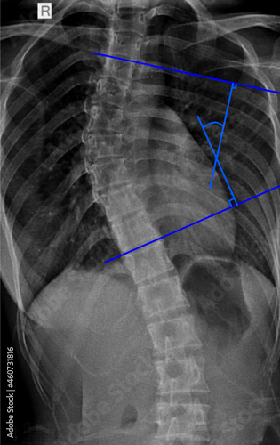 Cobb angle skoliosis vertebral xray