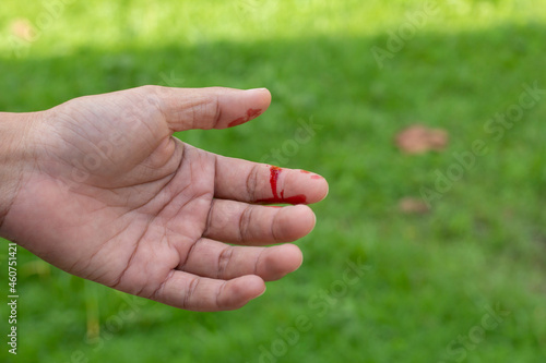 A man's hand was injured and bleeding due to accident. © Pannarai