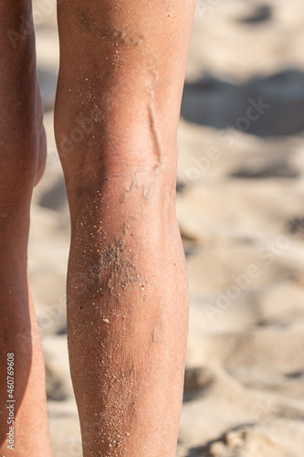 varicose veins on the male foot