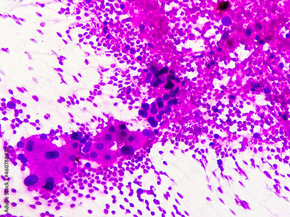 Hepatocellular dysplasia, cellular enlargement, nuclear pleomorphism, and multinucleation, light micrograph, photo under microscope 100x view