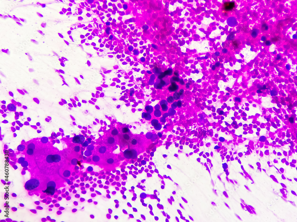 Hepatocellular dysplasia, cellular enlargement, nuclear pleomorphism, and multinucleation, light micrograph, photo under microscope 100x view Hepatocellular dysplasia, cellular enlargement, nuclear pleomorphism, and multinucleation, light micrograph, photo under microscope 100x view