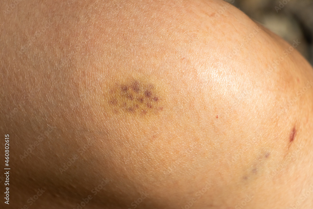 Background of bruised wound on wound woman at knee skin Background of bruised wound on wound woman at knee skin