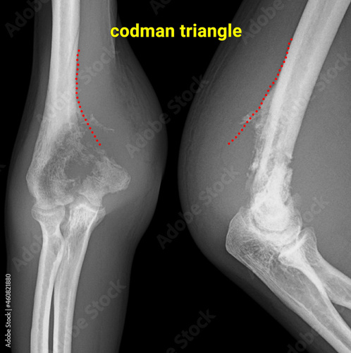x ray of a codman triangle osreosarcoma bone tumor vector