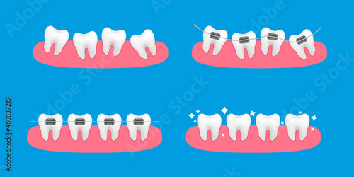 Braces on the teeth. White clear teeth with ceramic braces. Orthodontic treatment stages. Alignment of teeth and bite correction with the help of braces system. Vector Illustration