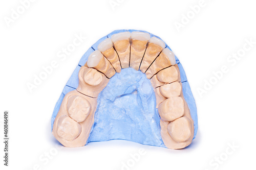 Veneers and crowns isolated on white background. Plaster model of teeth. lower jaw plaster model with prepared teeth. Working demountable plaster model. White front teeth veneers on diagnostic model