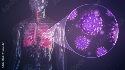 Coronavirus cells inside lungs. Pneumonia. Influenza type virus as dangerous flu. Pandemic medical health risk concept with disease cells inside human body. photo