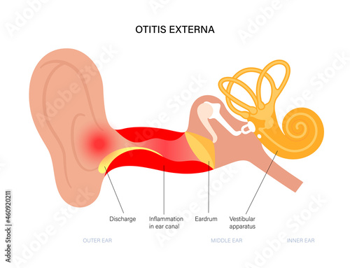 Swimmers ear otitis