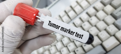 Blood sample for Tumor marker Test photo