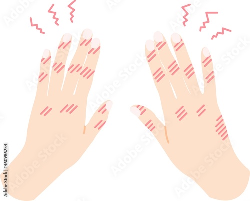 手荒れ しもやけ のイラスト