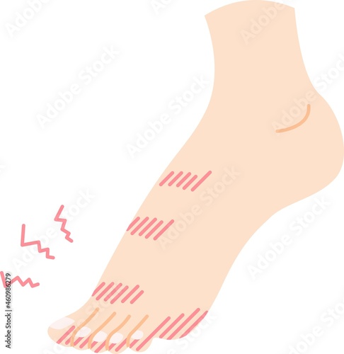 足のしもやけのイラスト