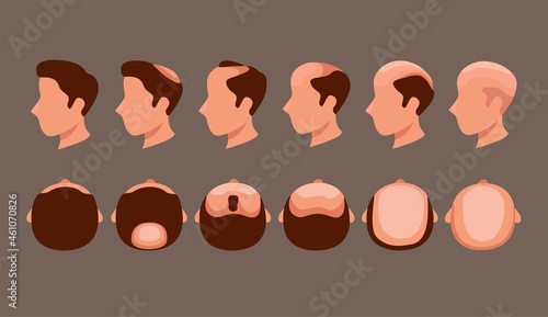 Man head with hairloss problem in side and top view symbol set illustration vector