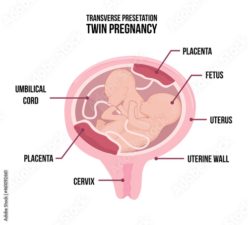 Anatomy of abdomen with twins. Pregnancy women diagrams
