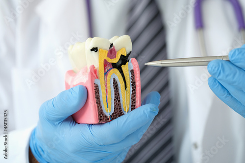 Doctor dentist showing pen on carious cavity on artificial plastic model of tooth closeup photo