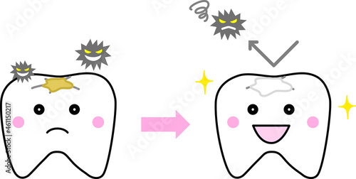食べかすの入りやすい歯の溝をシーラントで埋める