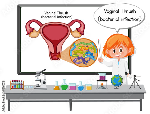 Young doctor explaining vaginal thrush (bacterial infection) photo