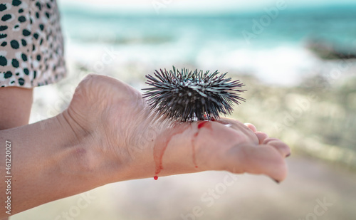 Das tut weh, der Seeigel steckt mit seinen Stacheln im Fuß und es blutet photo