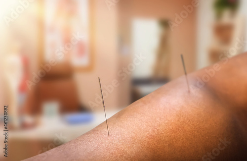 Acupuncture. doctor injects a needle into a patient's body with traditional Chinese medicine. health care concept