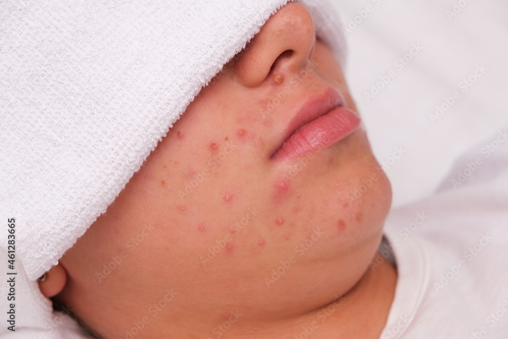 Acne. Close-up. Problematic skin in adolescents. cheeks and chin Acne. Close-up. Problematic skin in adolescents. cheeks and chin