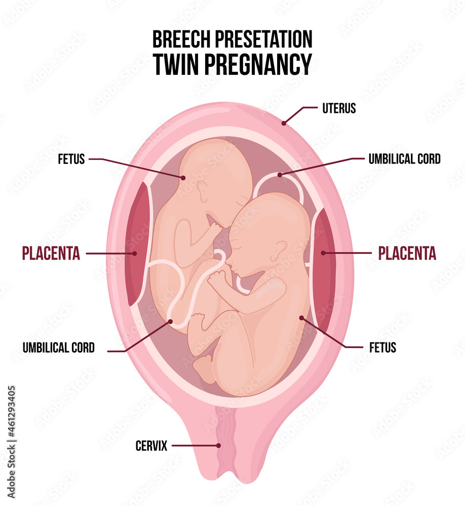 Obraz premium Anatomy of abdomen with twins. Pregnancy women diagrams with breech presentation for both children.